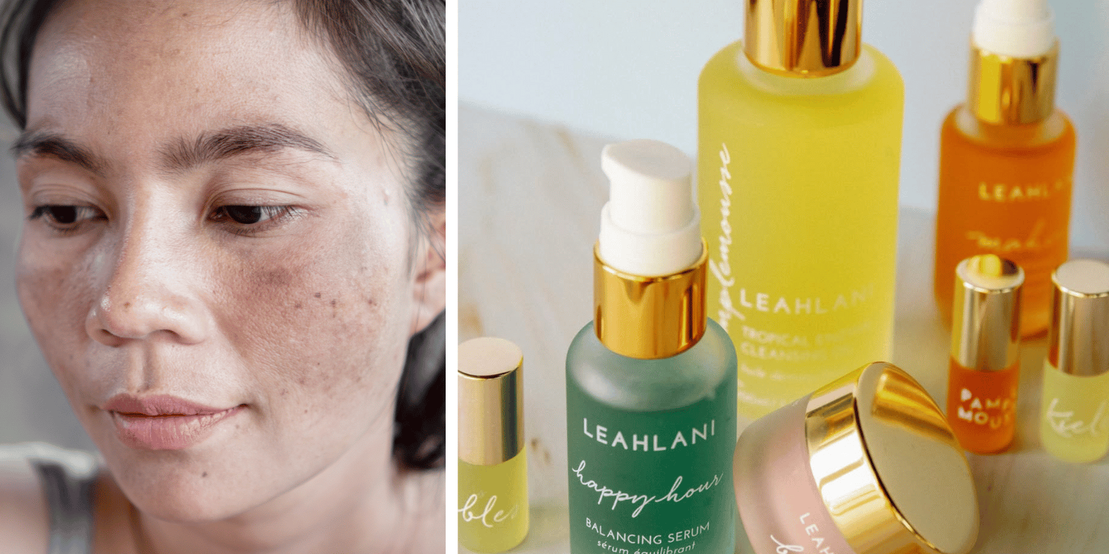 Top Skincare Picks for Hyperpigmentation